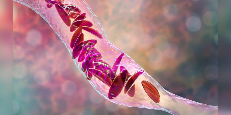 ICMR Study: नवजातों की जांच और समय पर इलाज से सिकल सेल एनीमिया मृत्यु दर 5% से भी कम