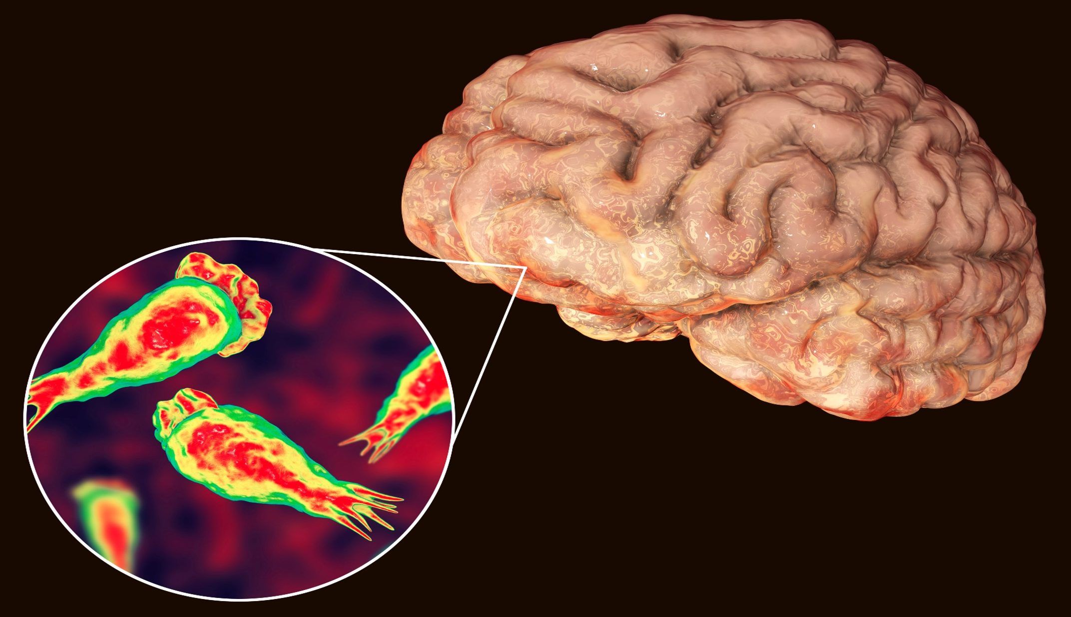 Meningoencephalitis: केरल में ‘ब्रेन ईटिंग अमीबा’ से 3 लोगों की मौत, 42 मामले आए सामने